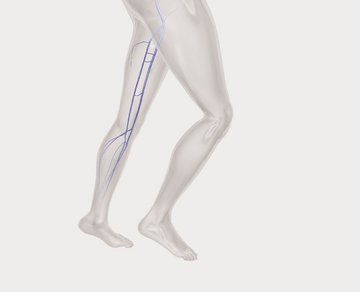 biolitec_KV_Phlebology_LQ